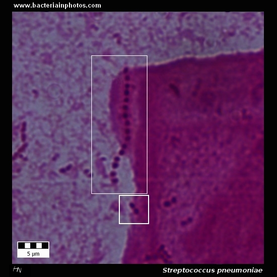pneumococcus   
                         microscopy, lanceolate gram-positive cocci